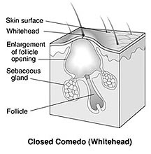 acne white heads