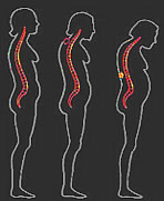 osteoporosis figure