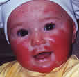 allergy baby face rash