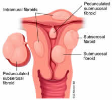 fibroids chart