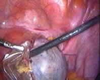 fibroids surgery